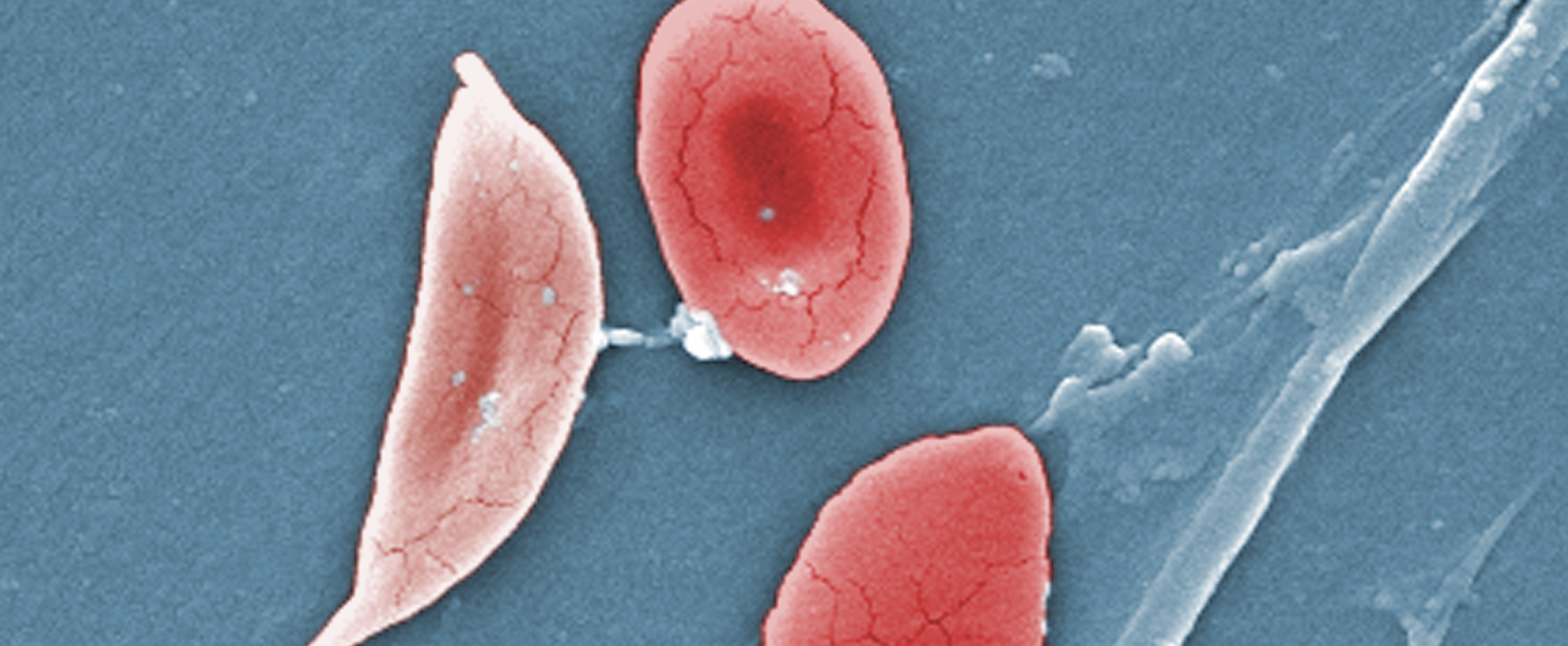 Slow progress towards treatment of sickle cell anemia ...