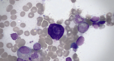 A large, dark blue-stained mast cell is seen in the center of the image, surrounded by unstained, smaller-sized bone cells