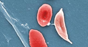 Normal and sickled red blood cells