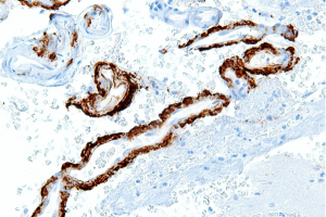 A microscope slide showing fragments of amyloid precursor protein aggregate in β-amyloid plaques