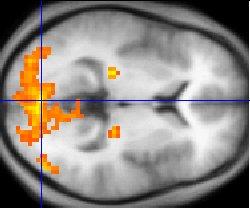 fMRI showing the activated visual cortex