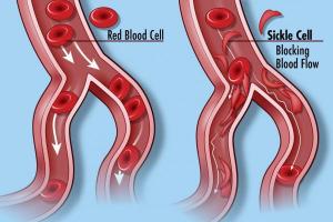In sickle cell disease, red blood cells may not flow smoothly through the circulatory system, often leading to severe complications.